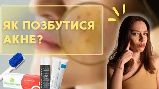 Як позбутися акне? Що викликає акне, помилки в догляді за шкірою, косметика від акне і комедонів