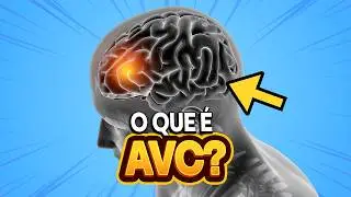 What is stroke?