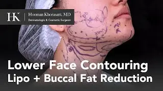 How to slim your face with Liposuction and Buccal Fat Reduction by Dr. Hooman Khorasani