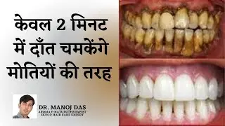 Teeth whitening at home in 2 minutes I how to naturally whiten your yellow teeth I DR. MANOJ DAS