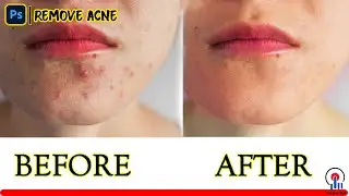 Remove Acne from Face in Photoshop #PhotoshopCC #PhotoshopCS6 #2021