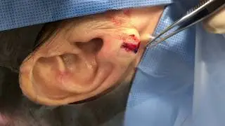 Essential Viewing for Split Earlobes