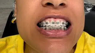 DID I NEED BRACES? Part 2 | The bottoms + STORY TIME BELOW