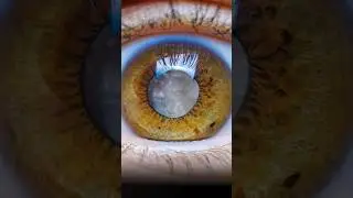 Animation - how Eye Cataract surgery is done 