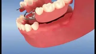 Prothèse amovible dentaire partielle, le dentier avec crochets