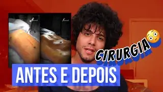 Lipo LAD avançada ! Resultado e perguntas