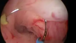 TCRM vagina pedunclated