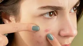¿Quieres eliminar la grasitud de tu rostro  una vez por todas? Mira este video