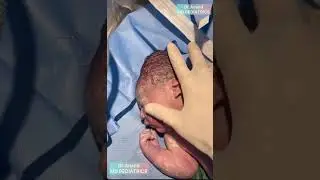What is the long term benefit of delayed cord clamping ? #pediatrics