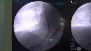 Transhepatic vein Permcath insertion(Fluoroscopic view)