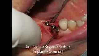 Tissue and Bone level screw retained Dental Prosthesis