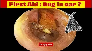 An insect in ear canal | First Aid