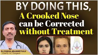 How to Treat Deviated Nasal Septum at Home | Correction of a Crooked Nose | | Socialpost Healthcare