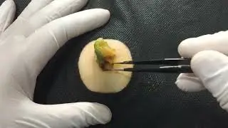 Treatment Of Blackhead Removal at Lam Dep Spa #038