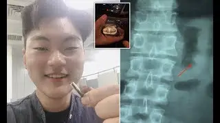 Man accidentally swallows AirPod. What happened then? 😱😱😱