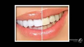 домашние отбеливание зубов   - Отбелите зубы за 1 неделю?