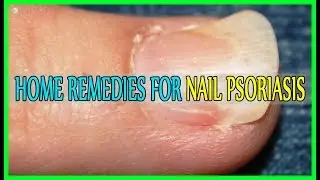 Best Home Remedies For Nail Psoriasis!