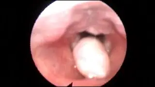 Рабдомиома гортани / Rhabdomyoma of Larynx
