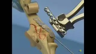 intra articular fracture distal humerus