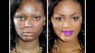 How To | Acne Coverage Foundation Routine