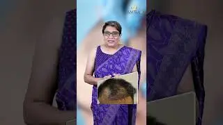 எந்த வயதில் ஹேர் ட்ரான்ஸ்பிளான்ட் (Hair Transplant) கொள்ளலாம் !