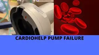 CARDIOHELP PUMP FAILURE