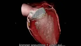 Koroner Anevrizma 2