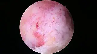 L Knee ACL with Biobrace, meniscal repair, microfx 5 8 23 SR