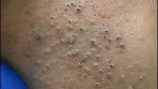 Deep Cleansing Techniques — Amazing Acne Removal Facial Care Routine