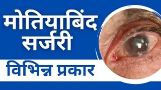 मोतियाबिंद सर्जरी के प्रकार | Types of Cataract Surgery