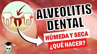 ALVEOLITIS DENTAL ¿Qué debo hacer? *Causas y Soluciones*
