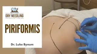 Dry Needling Piriformis