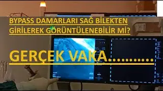 GERÇEK VAKA....BYPASS DAMARLARI SAĞ BİLEKTEN GİRİLEREK GÖRÜNTÜLENEBİLİR Mİ?