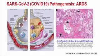 SARS - CoV-2 (COVID19), una pandemia - Dr. Josep Maria Miró PostCROI 2020