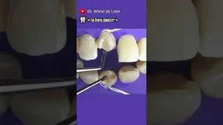 Hardest Tooth To Restore Esthetically with Composite 