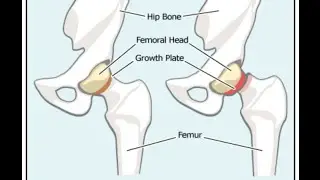 Slipped Capital Femoral Epiphysis (SCFE)