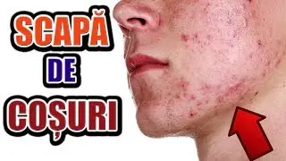 CUM SĂ AI O FAȚĂ CURATĂ CA ADOLESCENT | PIELE FĂRĂ COȘURI