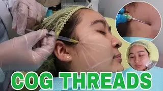 7D HIFU AND COG THREADS FACELIFT PROCEDURE || (ACTUAL PROCEDURE)