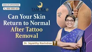 Will Your Skin Ever Be the Same After Tattoo Removal? Shocking Truth Revealed!