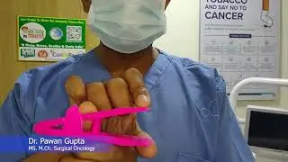 How to Measure Trismus with TrisCaRe in Hindi.  Dr. Pawan Gupta.  ICanCaRe