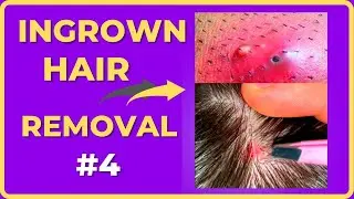 Ingrown hair removal videos [Compilations #4]  #ingrownhair #Compilations #내성발톱  #ingrownhairShorts
