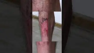 Burning the Skin OFF my Leg for Science... 