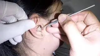 Young Woman's Huge Earwax is Finally Removed- She Seldom Cleans Her Ears