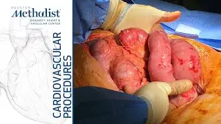 SMA Exposure, Thromboembolectomy, Patch Angioplasty and Retrograde Stenting (Peden, MD, Zubair, MD)