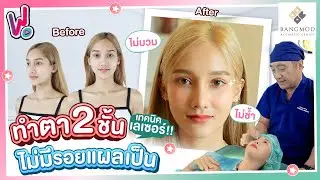 รีวิวพลีชีพ ทําตา2ชั้น เจ็บมั้ย ตาหลบใน ตาไม่เท่ากัน ด้วยเทคนิคเลเซอร์ ไม่บวม ไม่ช้ำ ไม่มีรอยแผลเป็น