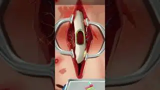asmr nose surgery animation #asmrsurgery #youtubeshorts #trendingshorts #trending