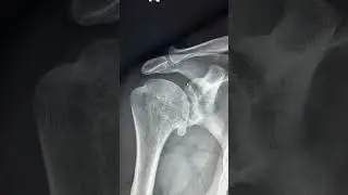 Glenohumeral osteoarthritis -X ray