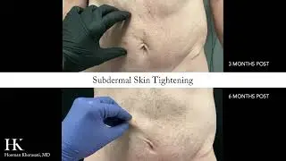 Subdermal Skin Tightening Before and After Pinch | Dr. Hooman Khorasani