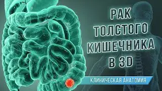 Рак толстого кишечника. Клиническая анатомия