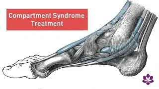 How to Treat Compartment Syndrome with Chair Massage Techniques